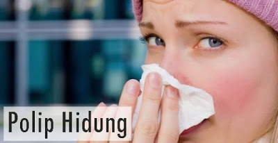  9 Faktor Resiko Pembentukan Polip Hidung